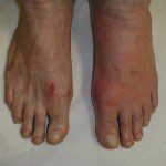Pictures of Gout in Feet