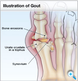 What is Gout? Gout and Hyperuricemia