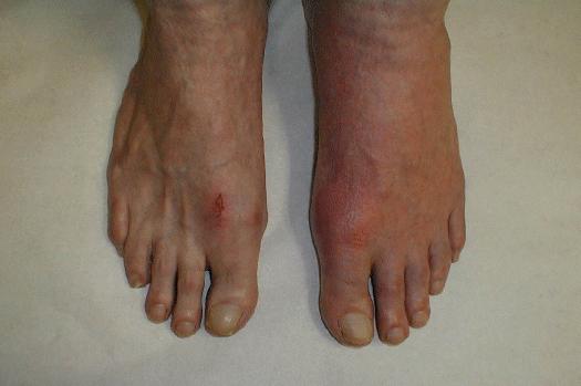 Picture of gout in feet