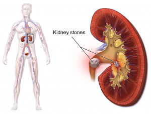 Kidney Stones and Gout