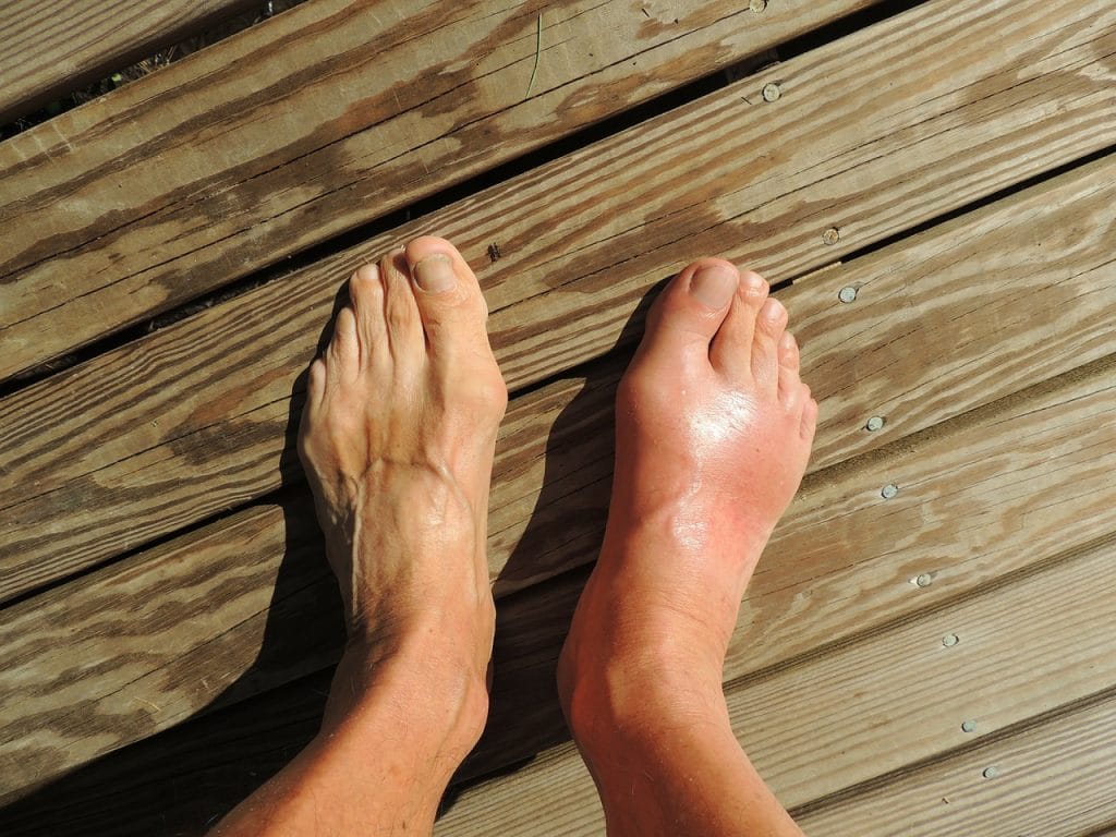 Picture of Gout in the Foot